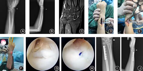 ulnar impaction special test|positive ulnar variance causes.